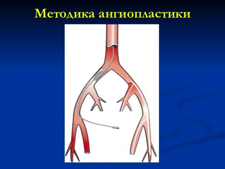 Методика ангиопластики