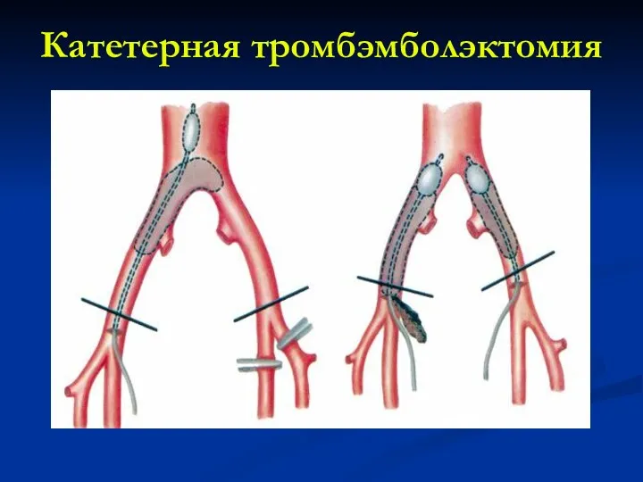 Катетерная тромбэмболэктомия