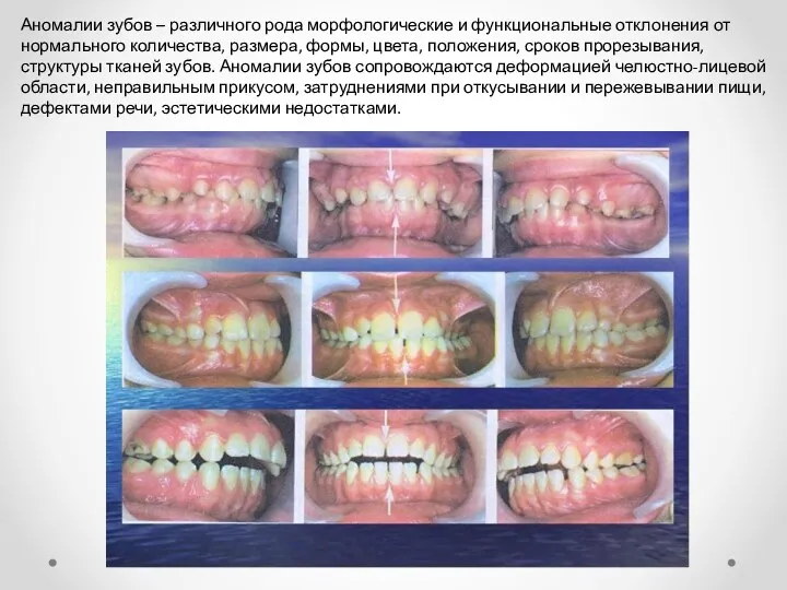 Аномалии зубов – различного рода морфологические и функциональные отклонения от
