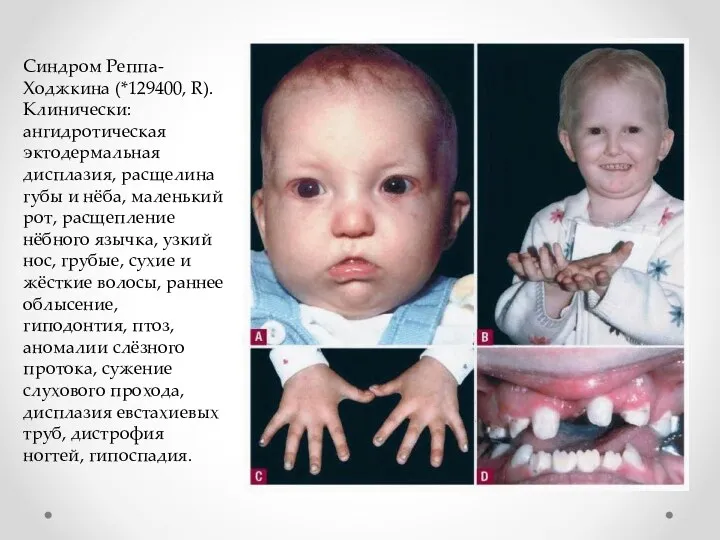 Синдром Реппа-Ходжкина (*129400, R). Клинически: ангидротическая эктодермальная дисплазия, расщелина губы