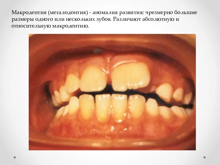 Макродентия (мегалодонтия) - аномалия развития: чрезмерно большие размеры одного или