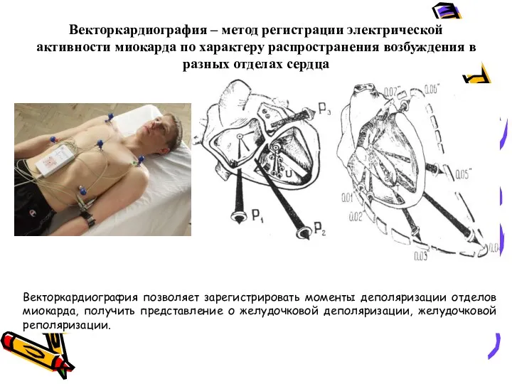 Векторкардиография – метод регистрации электрической активности миокарда по характеру распространения