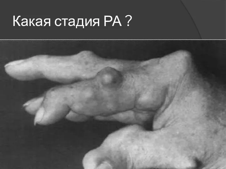 Какая стадия РА ?