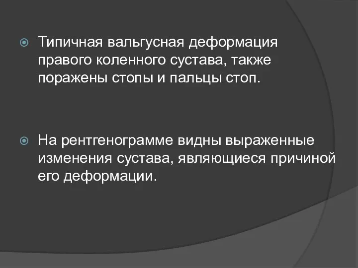 Типичная вальгусная деформация правого коленного сустава, также поражены стопы и