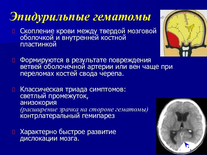 Эпидурильпые гематомы Скопление крови между твердой мозговой оболочкой и внутренней