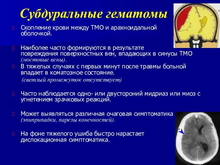 Субдуральные гематомы Скопление крови между ТМО и арахноидальной оболочкой. Наиболее
