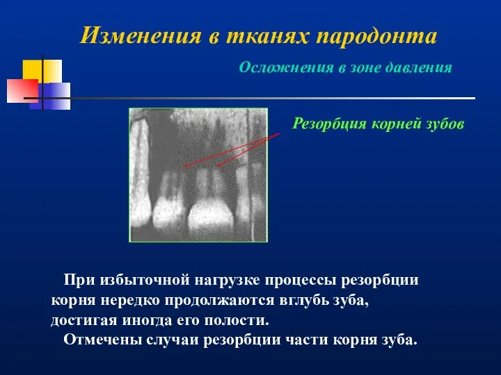 Изменения в тканях пародонта Резорбция корней зубов При избыточной нагрузке