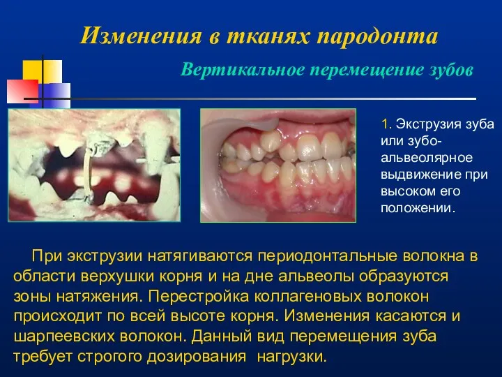 Изменения в тканях пародонта Вертикальное перемещение зубов 1. Экструзия зуба