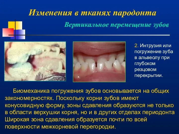 Изменения в тканях пародонта Вертикальное перемещение зубов 2. Интрузия или