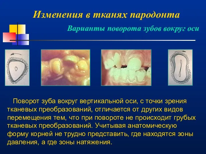 Изменения в тканях пародонта Варианты поворота зубов вокруг оси Поворот