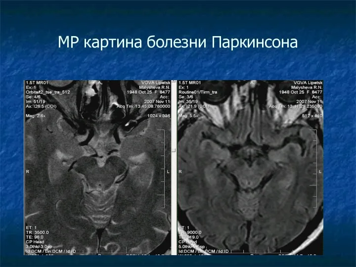 МР картина болезни Паркинсона