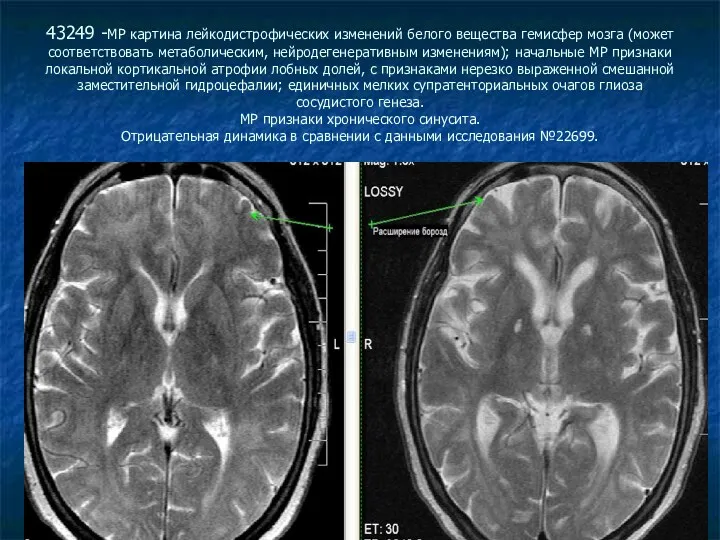 43249 -МР картина лейкодистрофических изменений белого вещества гемисфер мозга (может