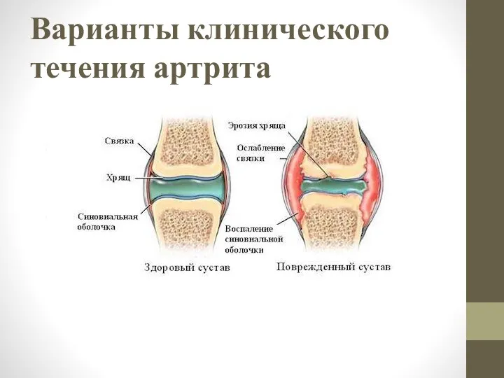 Варианты клинического течения артрита