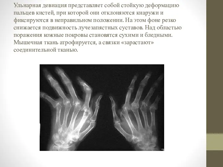 Ульнарная девиация представляет собой стойкую деформацию пальцев кистей, при которой