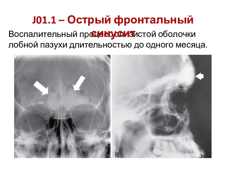Воспалительный процесс слизистой оболочки лобной пазухи длительностью до одного месяца. J01.1 – Острый фронтальный синусит