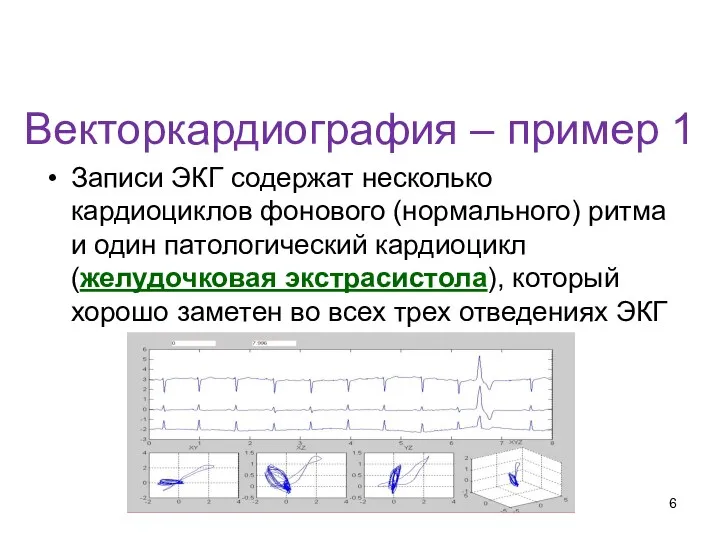 Векторкардиография – пример 1 Записи ЭКГ содержат несколько кардиоциклов фонового