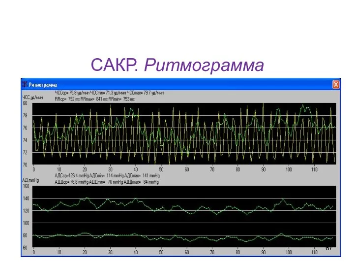 САКР. Ритмограмма