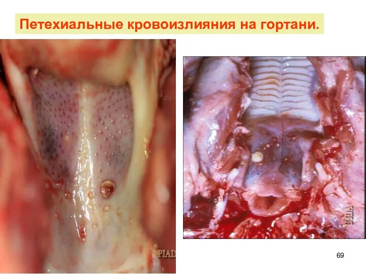 Петехиальные кровоизлияния на гортани.