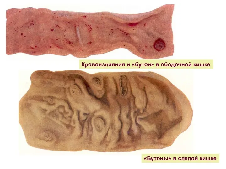 Кровоизлияния и «бутон» в ободочной кишке «Бутоны» в слепой кишке