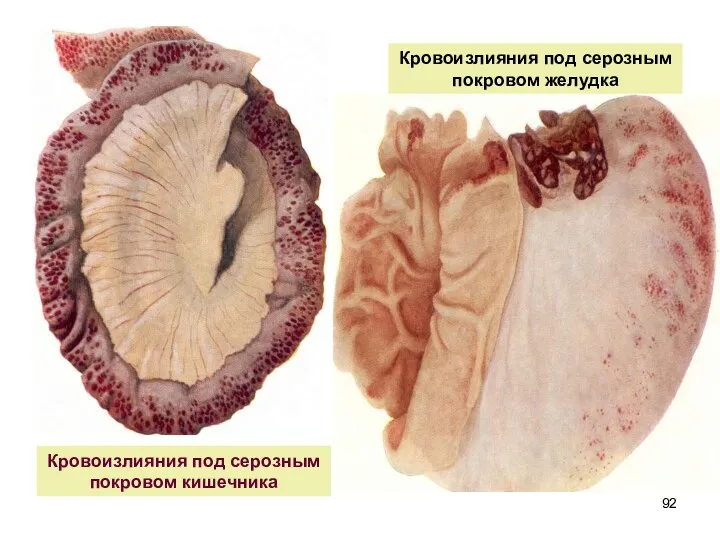 Кровоизлияния под серозным покровом желудка Кровоизлияния под серозным покровом кишечника