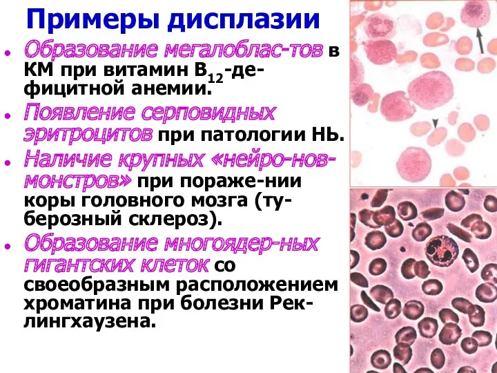 Примеры дисплазии Образование мегалоблас-тов в КМ при витамин В12-де-фицитной анемии.