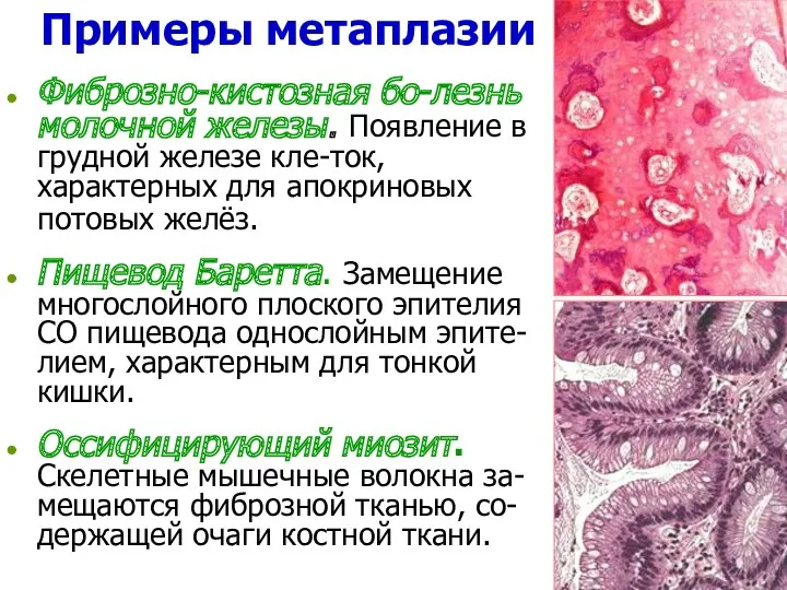 Примеры метаплазии Фиброзно-кистозная бо-лезнь молочной железы. Появление в грудной железе