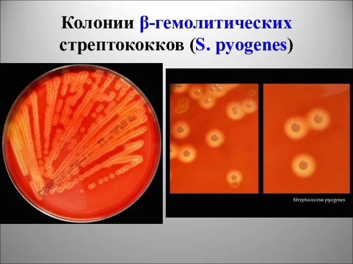 Колонии β-гемолитических стрептококков (S. pyogenes)