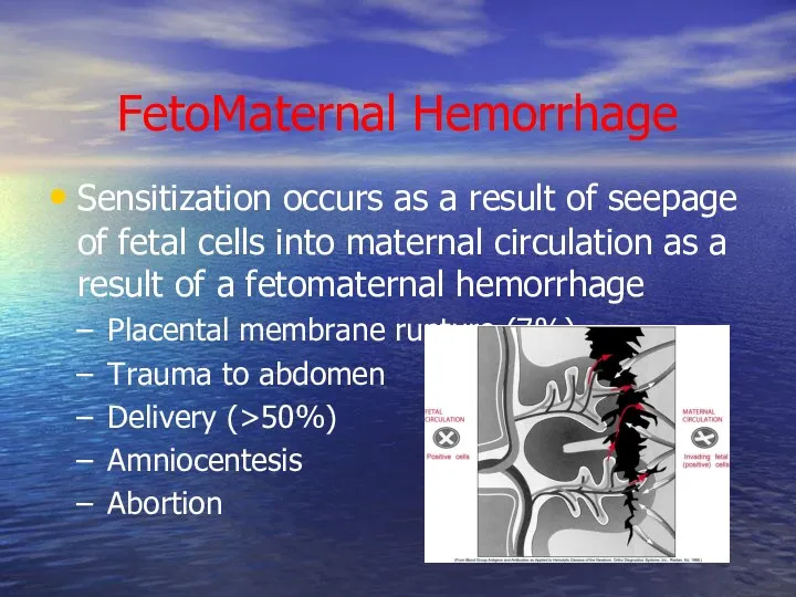 FetoMaternal Hemorrhage Sensitization occurs as a result of seepage of