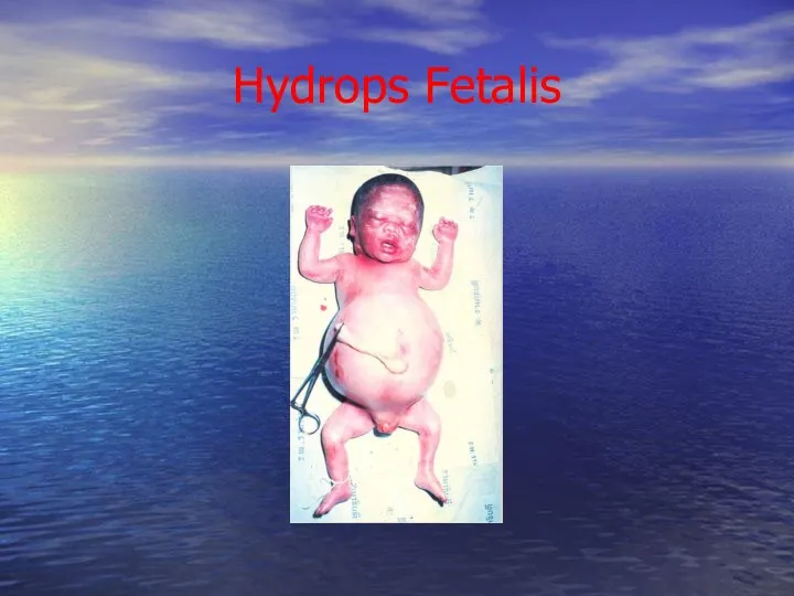 Hydrops Fetalis