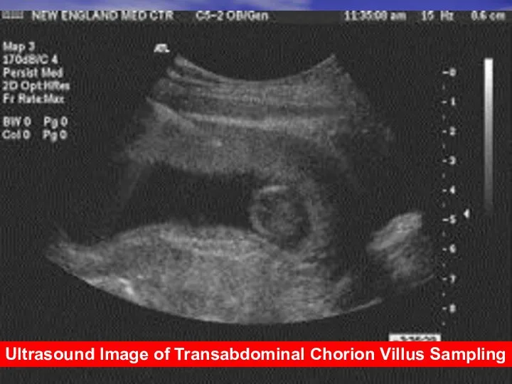 Ultrasound Image of Transabdominal Chorion Villus Sampling