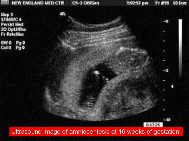 Ultrasound image of amniocentesis at 16 weeks of gestation
