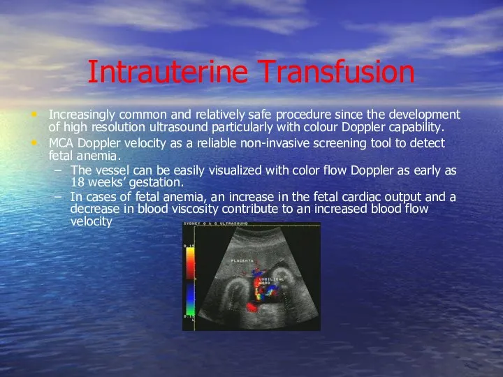 Intrauterine Transfusion Increasingly common and relatively safe procedure since the