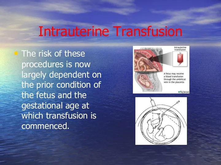 Intrauterine Transfusion The risk of these procedures is now largely