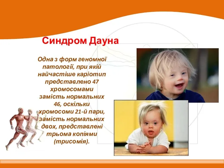 Синдром Дауна Одна з форм геномної патології, при якій найчастіше