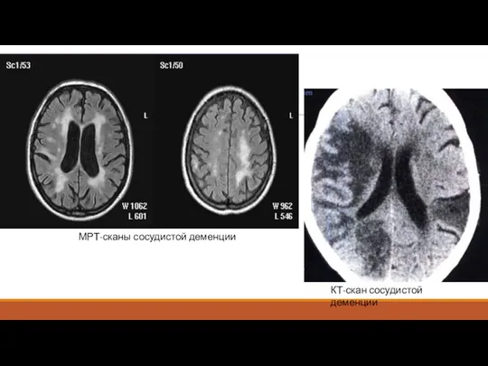 МРТ-сканы сосудистой деменции КТ-скан сосудистой деменции