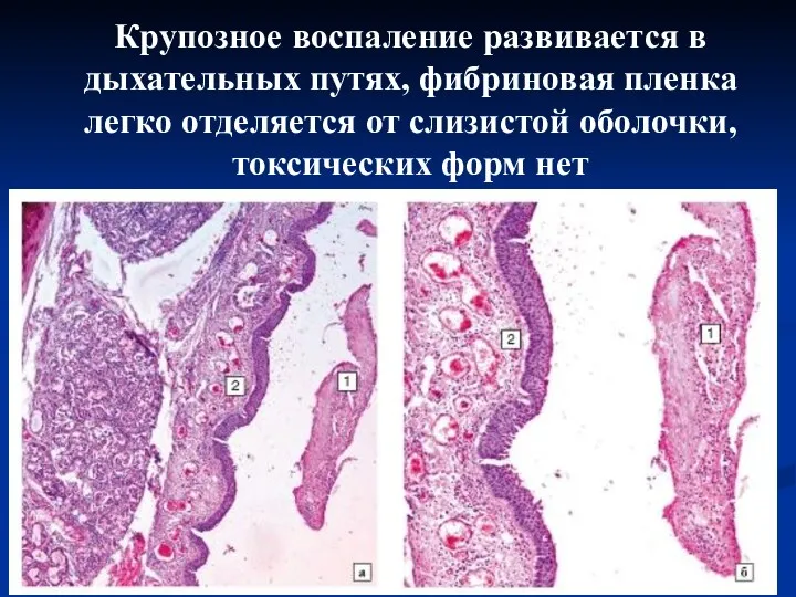 Крупозное воспаление развивается в дыхательных путях, фибриновая пленка легко отделяется от слизистой оболочки, токсических форм нет