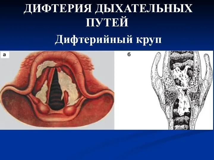 ДИФТЕРИЯ ДЫХАТЕЛЬНЫХ ПУТЕЙ Дифтерийный круп