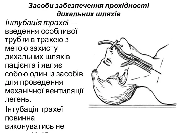 Засоби забезпечення прохідності дихальних шляхів Інтубація трахеї — введення особливої