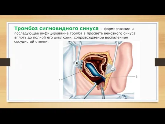 Тромбоз сигмовидного синуса – формирование и последующее инфицирование тромба в