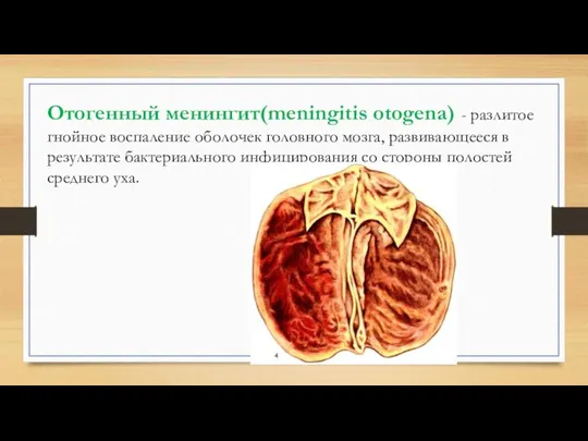Отогенный менингит(meningitis otogena) - разлитое гнойное воспаление оболочек головного мозга,
