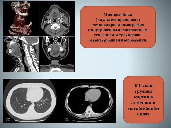 Многослойная («мультиспиральная») компьютерная томография с внутривенным контрастным усилением и трёхмерной реконструкцией изображения. КТ-скан