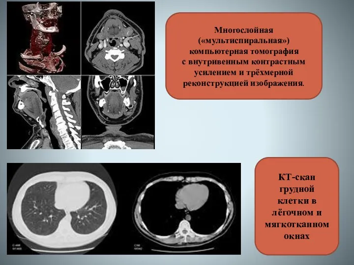 Многослойная («мультиспиральная») компьютерная томография с внутривенным контрастным усилением и трёхмерной