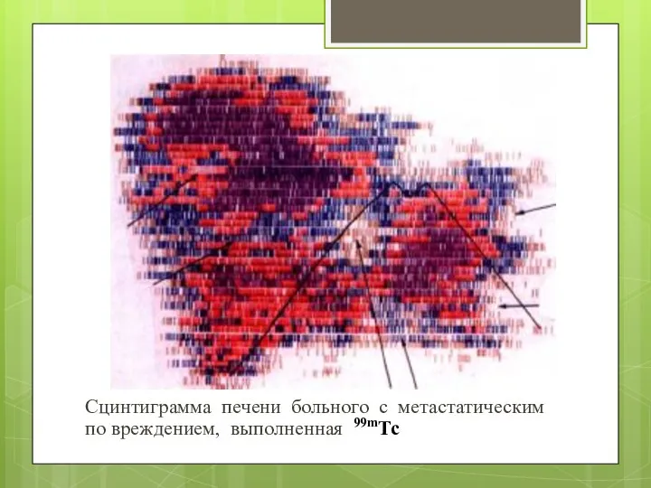 Сцинтиграмма печени больного с метастатическим по вреждением, выполненная 99mТс