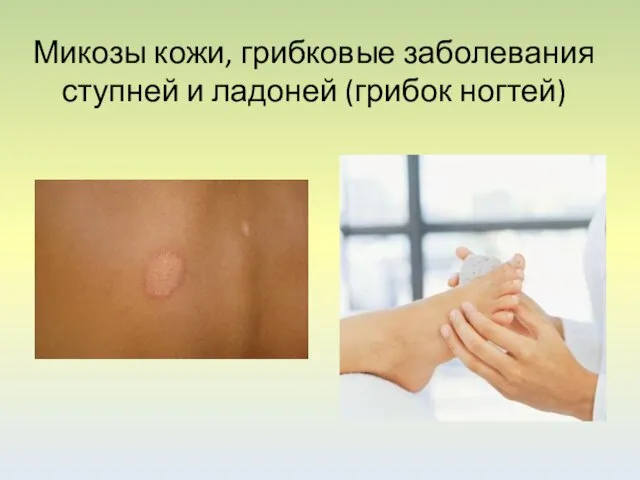 Микозы кожи, грибковые заболевания ступней и ладоней (грибок ногтей)