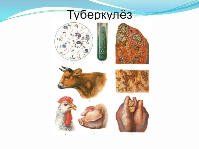 Туберкулёз