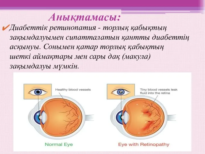 Анықтамасы: Диабеттік ретинопатия - торлық қабықтың зақымдалуымен сипатталатын қантты диабеттің