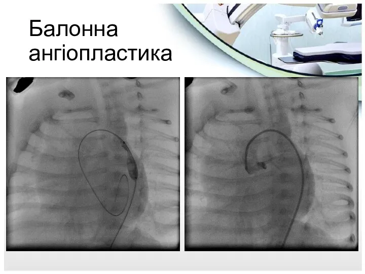 Балонна ангіопластика