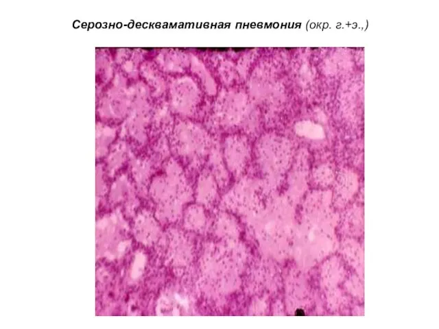 Серозно-десквамативная пневмония (окр. г.+э.,)