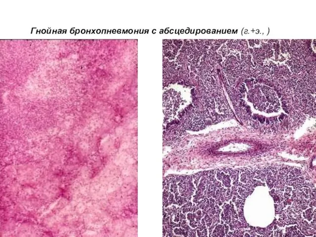 Гнойная бронхопневмония с абсцедированием (г.+э., )