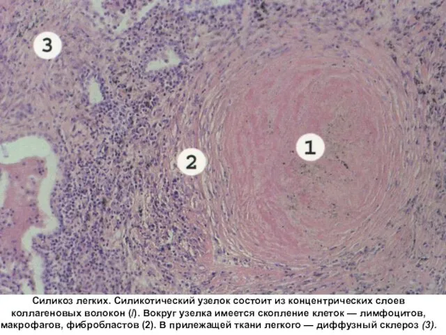 Силикоз легких. Силикотический узелок состоит из концентрических слоев коллагеновых волокон